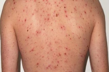 Se registró un muerto por dengue y otro por sarampión