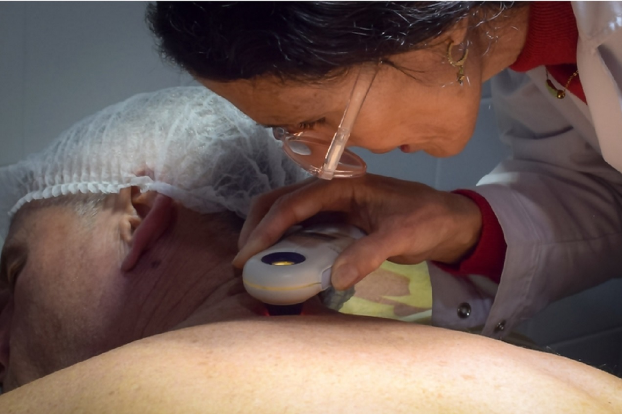 Salud promueve la consulta temprana de revisión de lesiones para prevenir el cáncer de piel